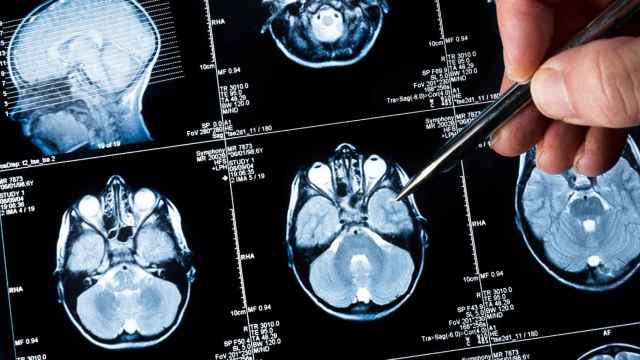 Golpe al cáncer cerebral más frecuente: frenan los ritmos noche-día que promueven su crecimiento