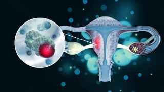 Cáncer de cuello uterino: estos son los síntomas del tumor que cada vez afecta a más mujeres