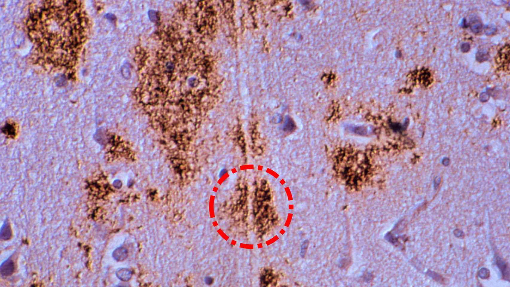 Placa amiloide rodeando la dendrita (tallo) de una neurona de una anciana con alzhéimer.