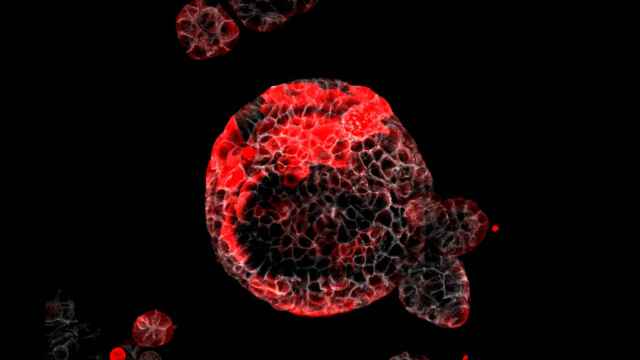 Las células responsables de la recaída, en rojo, sobre un organoide de tumor colorrectal.
