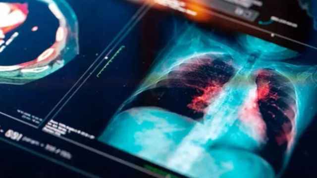 Se espera que en dos años el cáncer de pulmón sea la primera causa de muerte por tumor en mujeres.