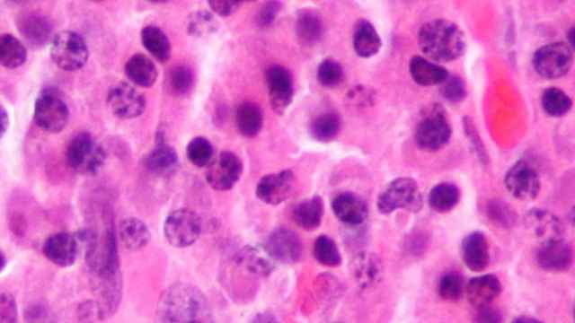 Células cancerígenas en plasma sanguíneo.