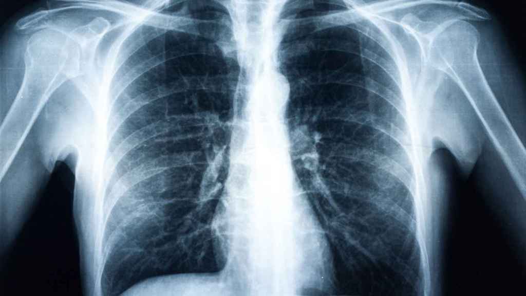 Pulmones en una radiografía.