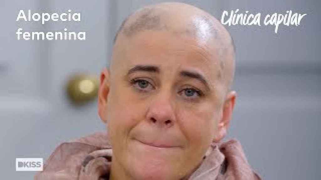 Alopecia femenina en Clínica Capilar