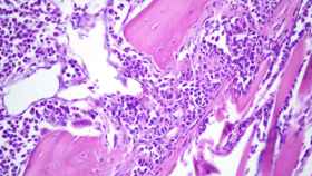 Las células cancerosas del mieloma múltiple en la médula espinal. EP.