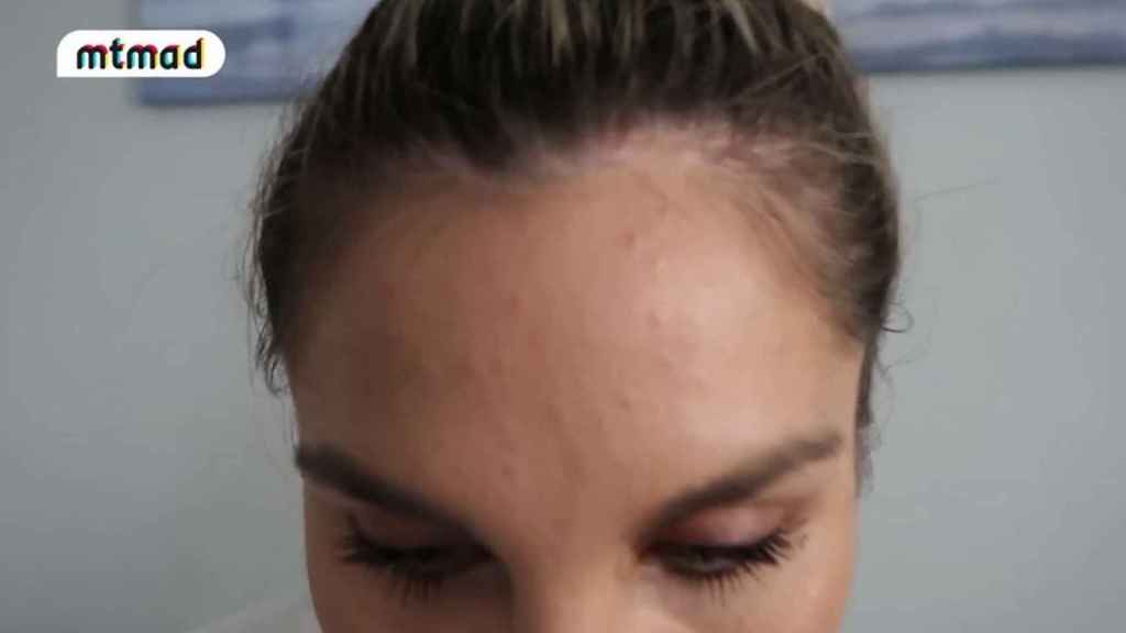 Ivana Icardi mostró en su canal de Mtmad su brote de acné.