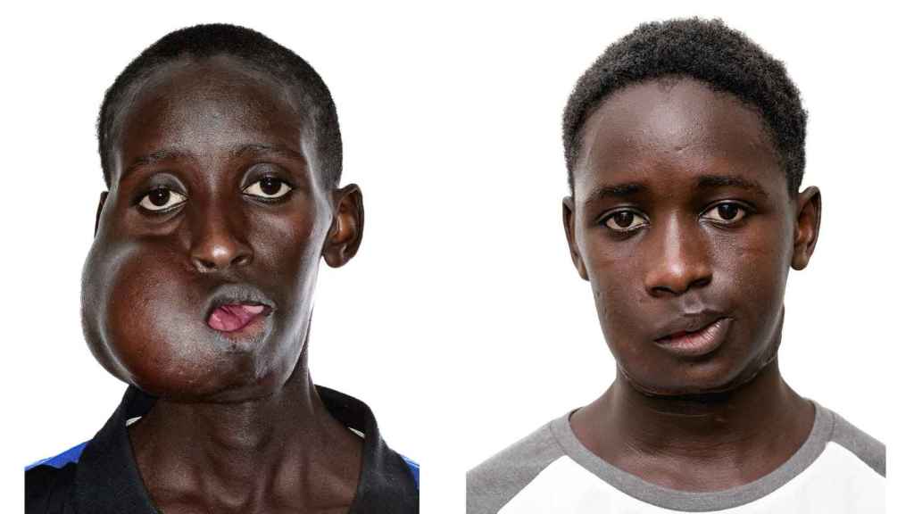 Mamadou Seydou, antes y después de la intervención quirúrgica.
