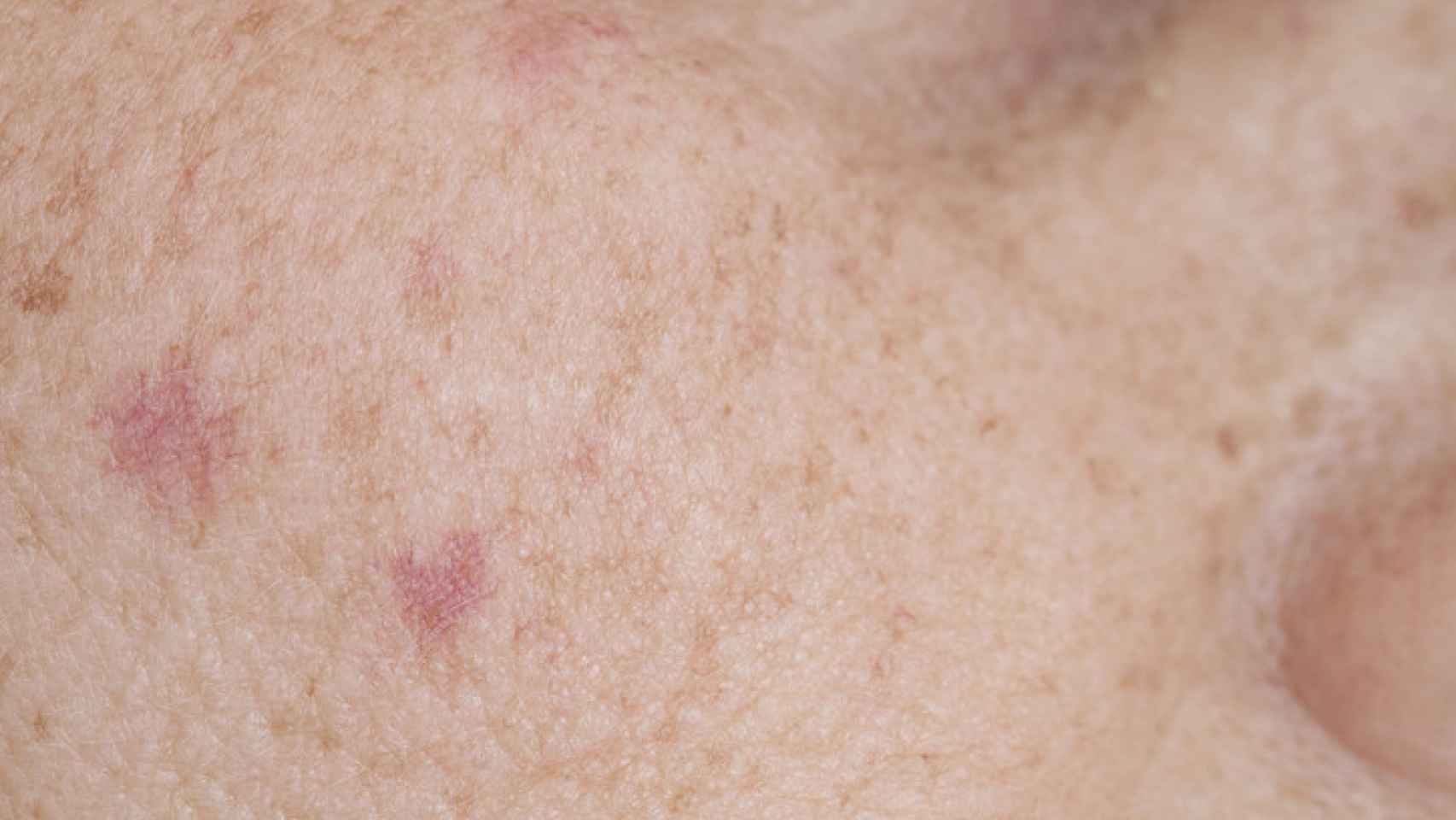 ¿Cómo eliminar las manchas de la cara? 3 tratamientos recomendados por los dermatólogos