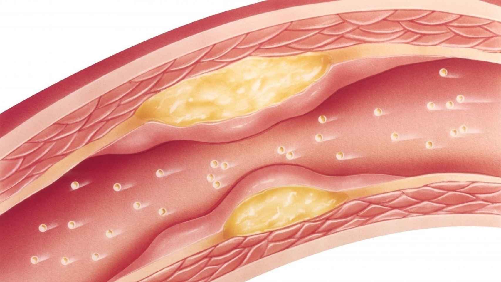 Acumulación de grasa en las arterias. EP.