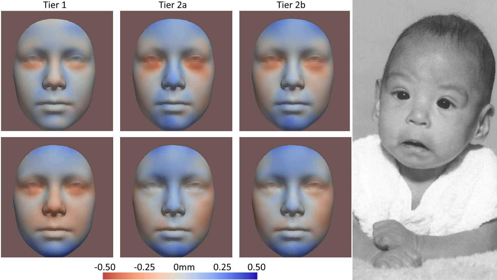Diagrama de las deformidades y fotografía de un bebé con síndrome de alcohol fetal (Liu, et al., Human Reproduction, 2023)/Teresa Kellerman (Wikimedia commons)