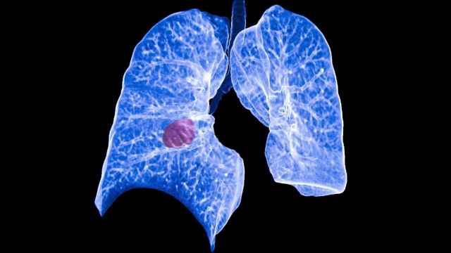Evolución del cáncer de pulmón.