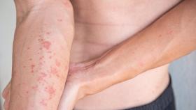 Dermatitis atópica.