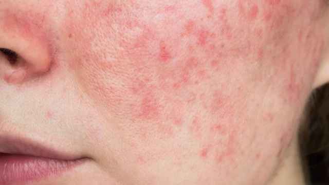 Dermatitis causada por la reacción a la henna negra.