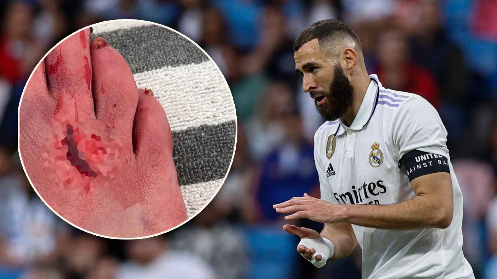 Benzema recibió cinco puntos de sutura en el pie