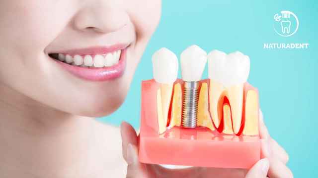 Diferencias entre la implantología dental inmediata y la convencional