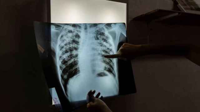 Radiografía de tuberculosis.