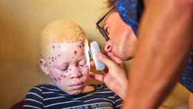 Dermatólogos de diferentes países se desplazan a Mozambique para ayudar a las personas con albinismo a combatir el cáncer de piel