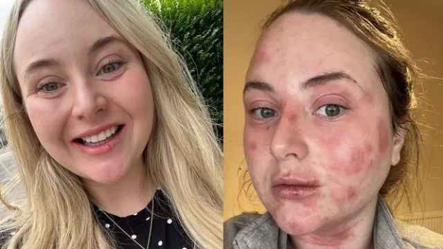 Antes y después de la reacción alérgica que sufrió Lily Lindsay.
