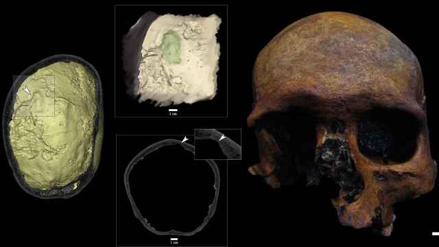 Modelo 3D virtual e imagen de MicroCT del cráneo de la sima de Marcenejas donde se indica la lesión que corresponde al tumor craneal, y la calavera tras su restauración.