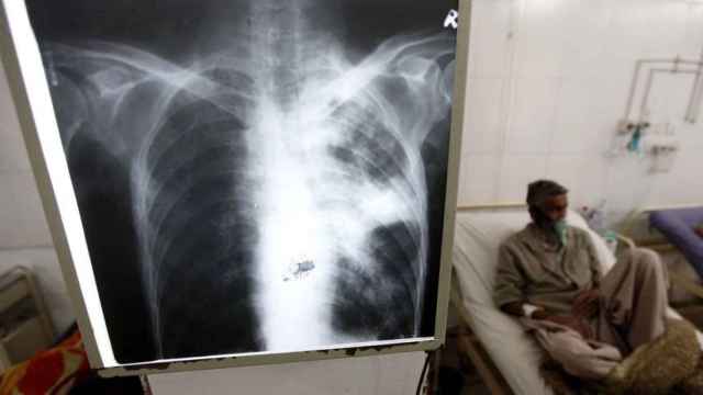 La tuberculosis mató a 1,3 millones de personas en 2022.